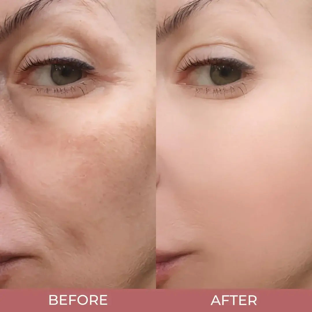 Before and after image showing visible improvement in skin texture, brightness, and smoothness after using Skin Aura Peel Shot exfoliating serum