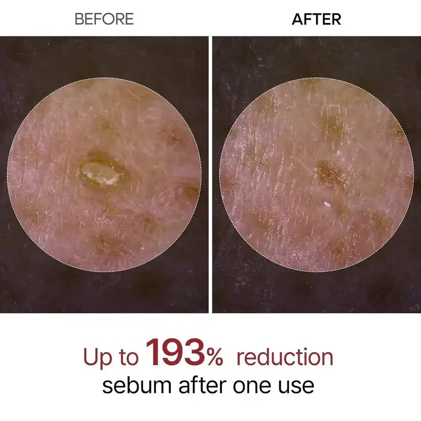 Microscopic before and after comparison showing 193% sebum reduction after one use of Skin Aura Peel Shot exfoliating treatment.