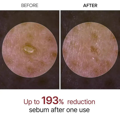 Microscopic before and after comparison showing 193% sebum reduction after one use of Skin Aura Peel Shot exfoliating treatment.